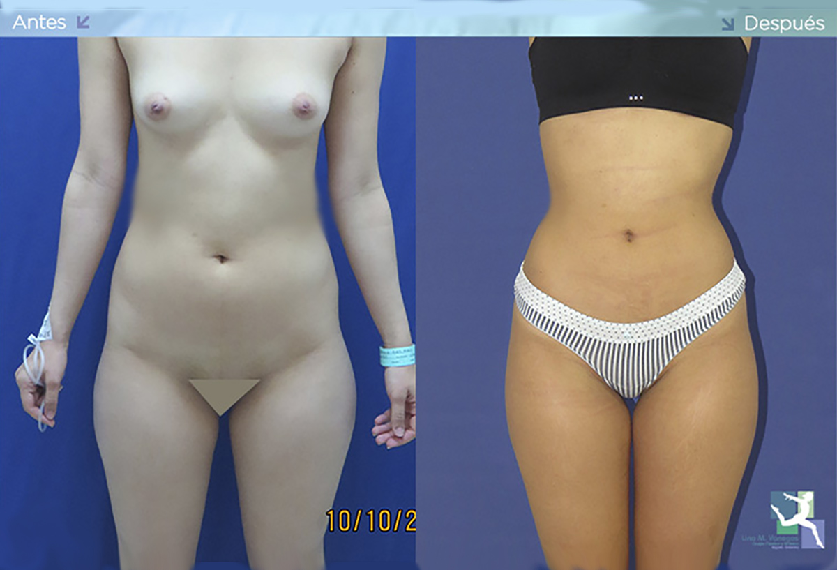 Lipoescultura o liposucción – Cirugía Estética Medellín Colombia