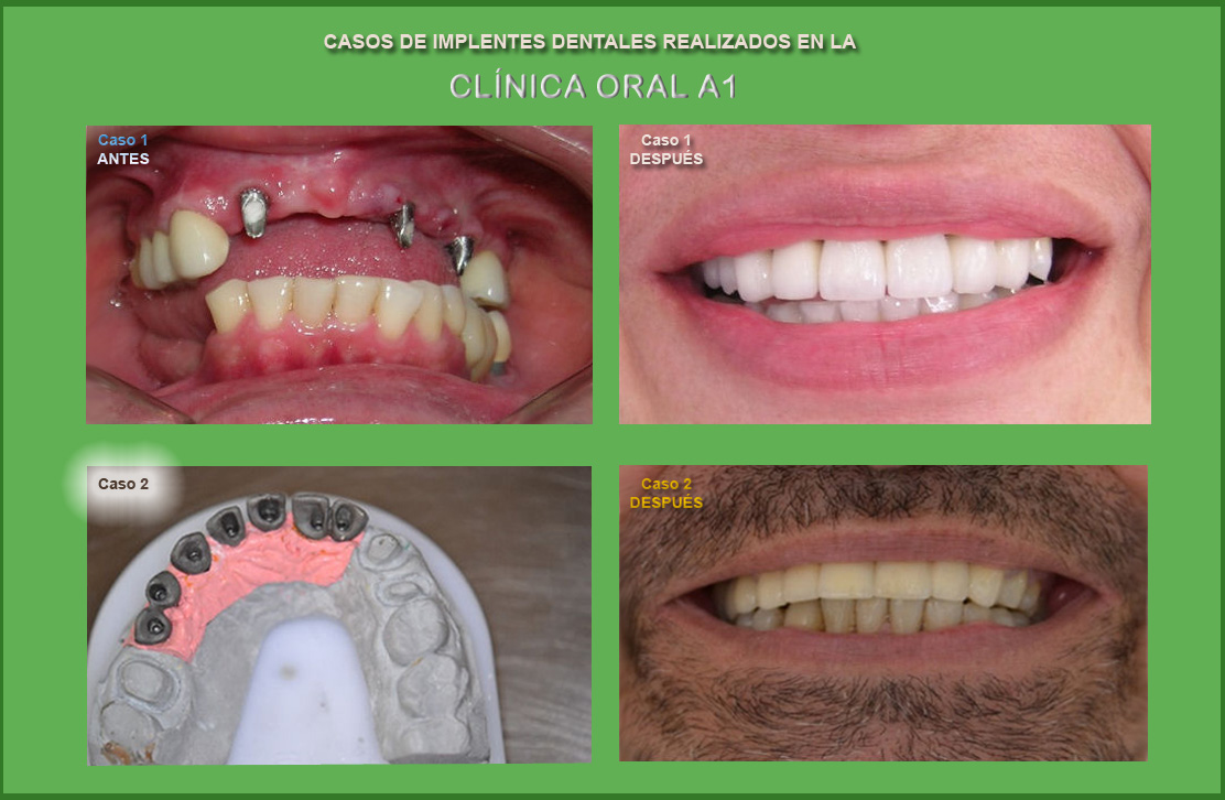 implantes-dentales-A1